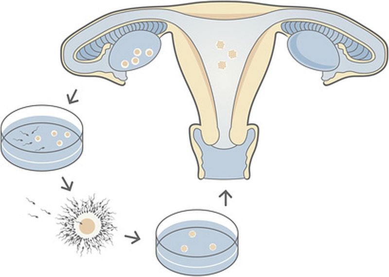 In-vitro_fertilization_(IVF)