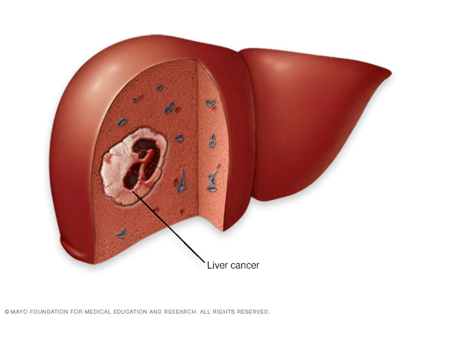 Información Cáncer de Hígado