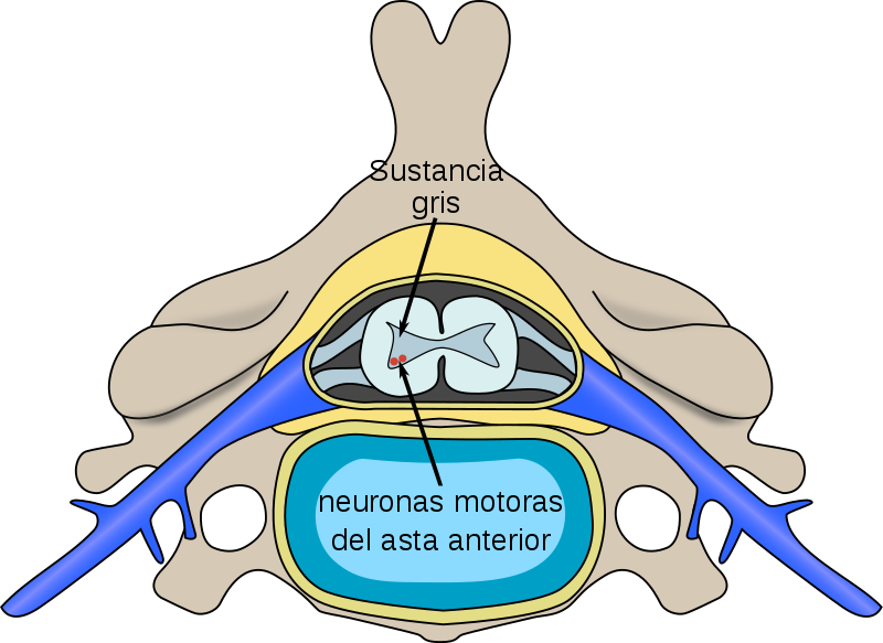 Wikipedia Atrofia Muscular Espinal